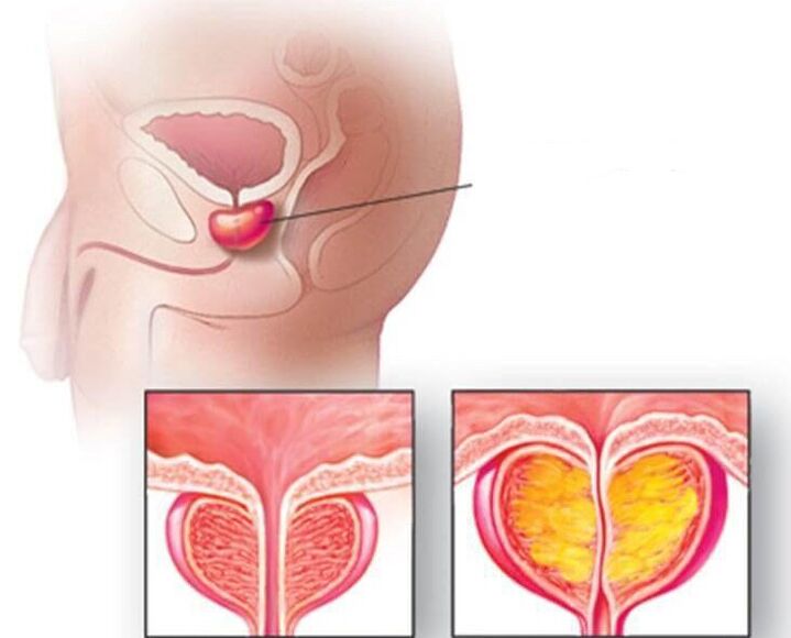 Prostatas dziedzera atrašanās vieta, normāla prostata un palielināta hroniska prostatīta gadījumā