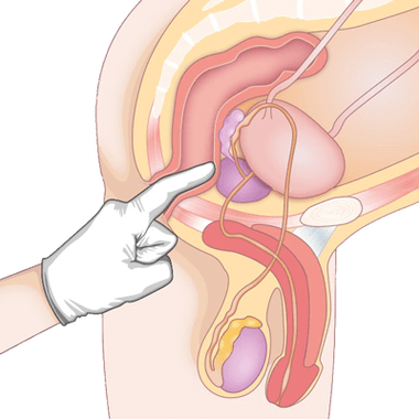 Prostatas stāvokļa noteikšana ar palpāciju prostatīta diagnostikai