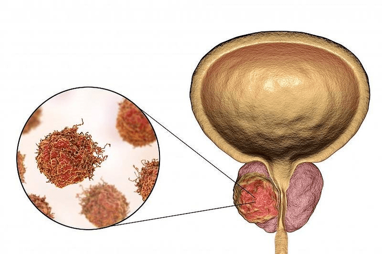 kā izskatās prostatas bojājumi