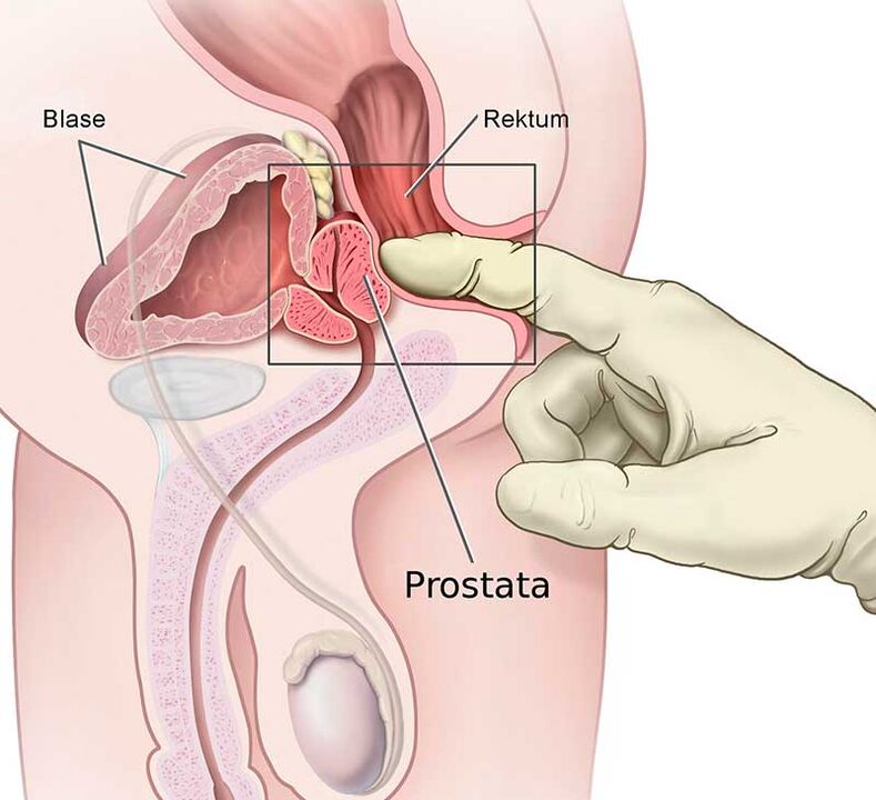 prostatas masāža prostatīta ārstēšanai