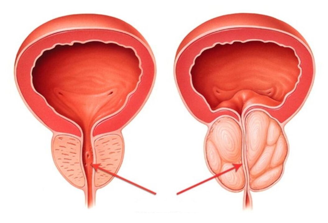 vesela un iekaisusi prostata ar prostatītu