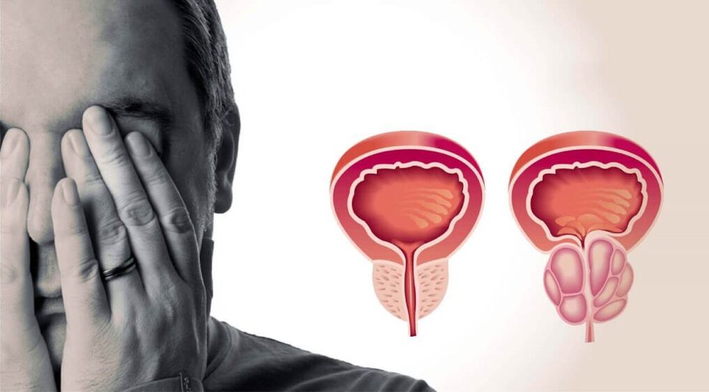 Vesela un iekaisusi prostata